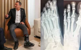 Özgür Özel’in ayağına ne oldu? CHP lideri Özgür Özel’in sağlık durumu nasıl?